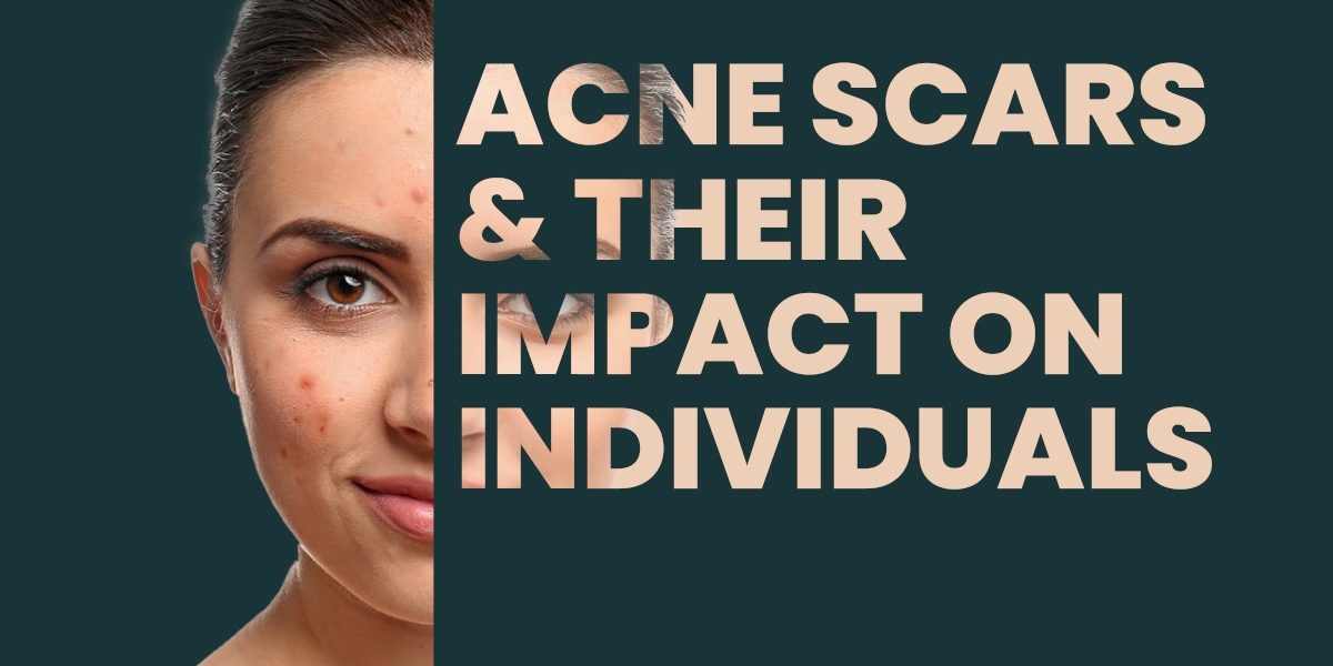 Acne Scars & their impact